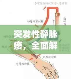 突发性静脉瘘,全面解析、预防与治疗策略